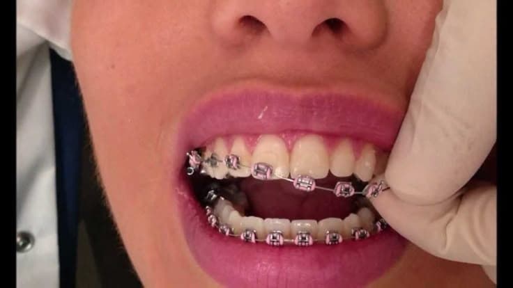 Braces and Aligners
