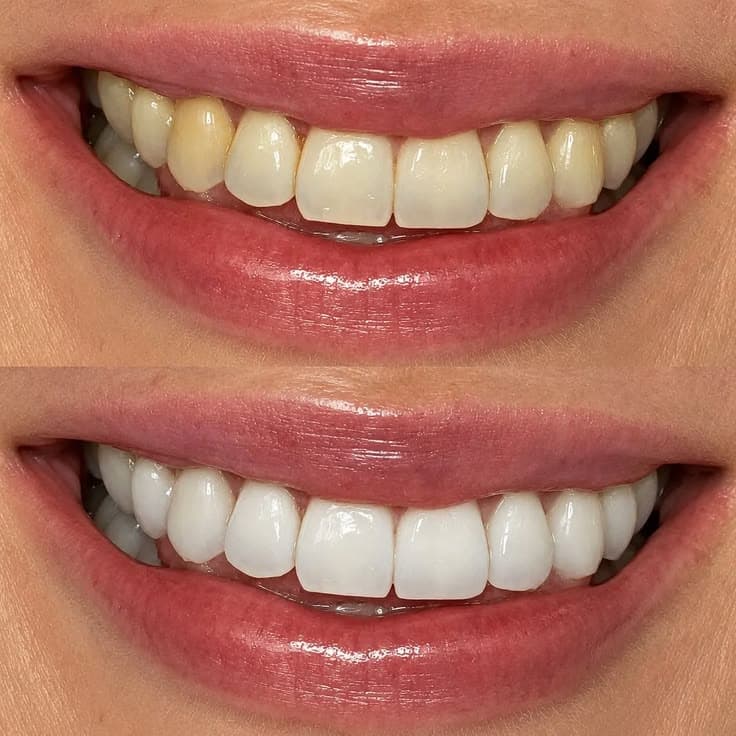 Cosmetic Dental Treatment & Veneers