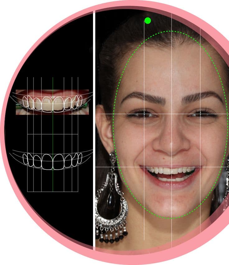 Smile Designing