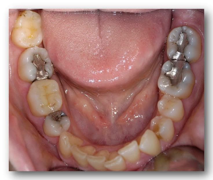 Tooth Fillings