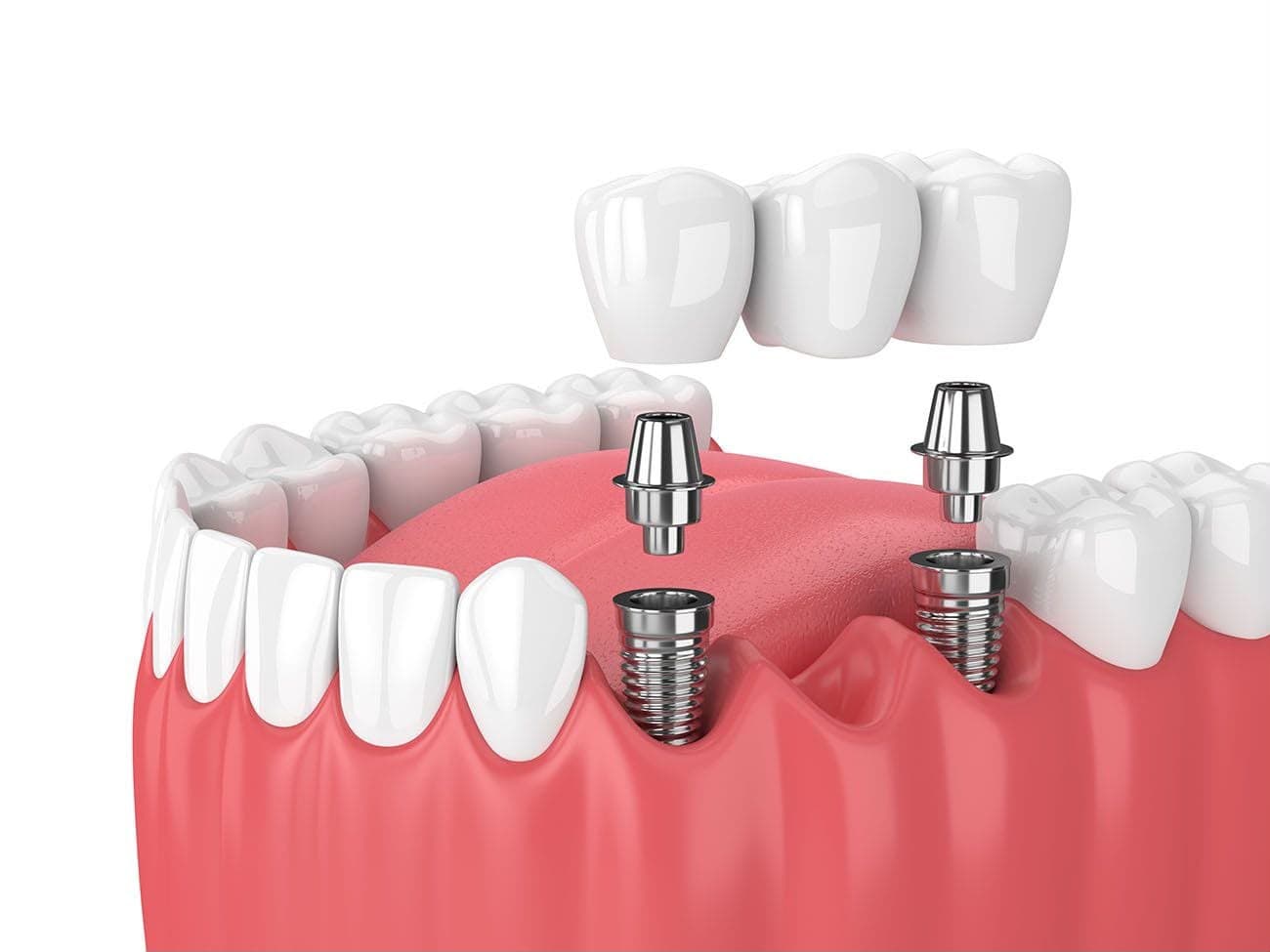 Tooth Fillings
